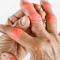The Power of Exercise in Homeopathic Treatment for Uric Acid