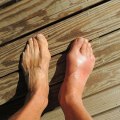 The Power of Homeopathy in Preventing High Uric Acid Levels