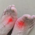 The Power of Stress Management in Homeopathic Treatment for Uric Acid
