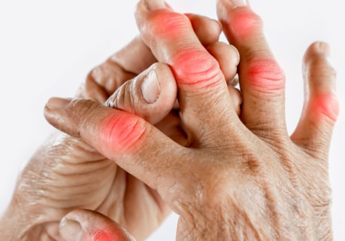 The Power of Exercise in Homeopathic Treatment for Uric Acid