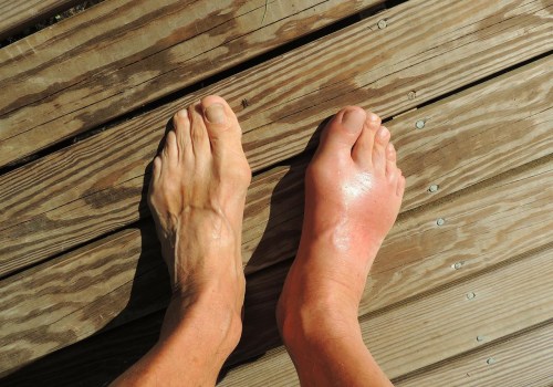 The Power of Homeopathy in Preventing High Uric Acid Levels